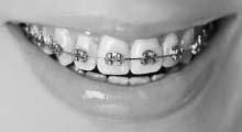 Metal Braces