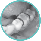 Fixed orthodontic appliance