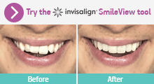 Invisalign Smileview